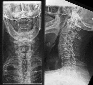 Жатыр мойны омыртқасының рентгенографиясы - остеохондрозды диагностикалау әдісі